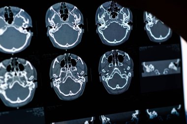 Beyin CT taraması x-ray filmi veya hesaplanmış tomografi görüntüsü Beyin