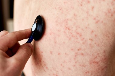 Ciltte alerjik kızarıklık. Sırt derisinde dermatoloji sorunu olan bir kadın.
