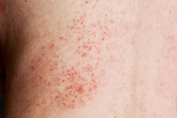 Allergic rash on the skin. Woman with dermatology problem on back skin