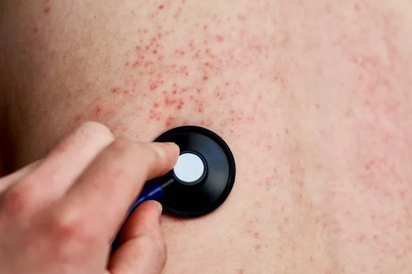 Erupção Alérgica Pele Mulher Com Problema Dermatológico Pele Das Costas — Fotografia de Stock