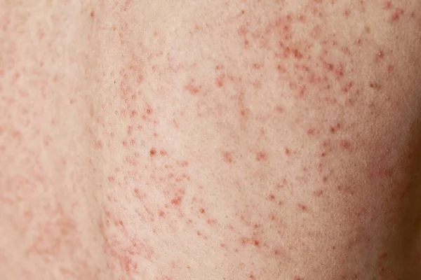 Wysypka Alergiczna Skórze Kobieta Problemami Dermatologicznymi Tylnej Skórze — Zdjęcie stockowe