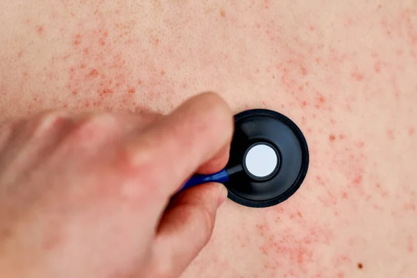 Erupção Alérgica Pele Mulher Com Problema Dermatológico Pele Das Costas — Fotografia de Stock