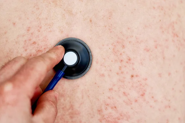 Ciltte Alerjik Kızarıklık Sırt Derisinde Dermatoloji Sorunu Olan Bir Kadın — Stok fotoğraf