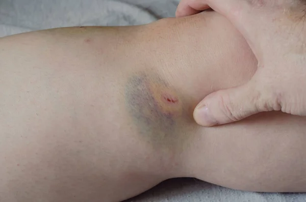 Hand indicates bruising and wounds to the female leg. Caucasian middle-aged woman shows hematoma and skin injuries. Domestic violence or an accident.