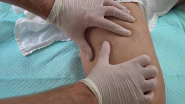 Il medico esamina la gamba di un paziente con vene varicose. Tromboflebite — Video Stock