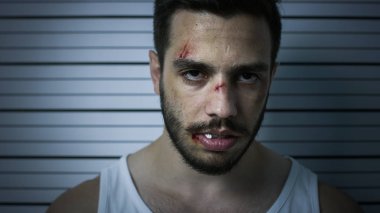 Bir Polis Karakolu'nda Tutuklanan Dövülmüş Adamın Yakın Çekim Portre Çekimi Front View Mugshot için Pozlar. O Singlet giyer, Ağır Çürük olduğunu. Arka Plandaki Yükseklik Grafiği.