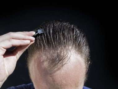 Kafa derisi ve karanlık bir arka plan karşı uzaklaşıyorsun saç çizgisi ile beyaz bir saçsız adamın kafatası.