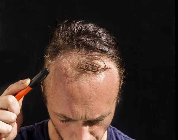 The scalp and skull of a caucasian balding man with a receding hairline against a dark background.