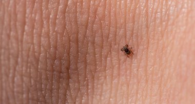 Bir Hint fasulyesi kenesi (Ixodes ricinus) insan derisi üzerinde sürünüyor.