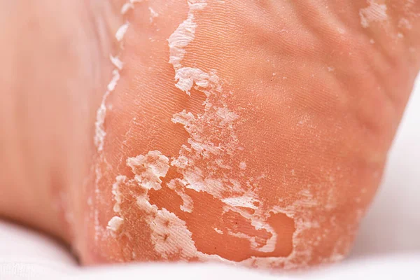 Skin peeling on the sole of a foot.