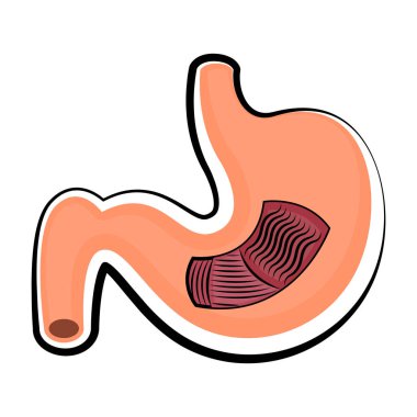 İnsan mide kesti. Renkli çizimi