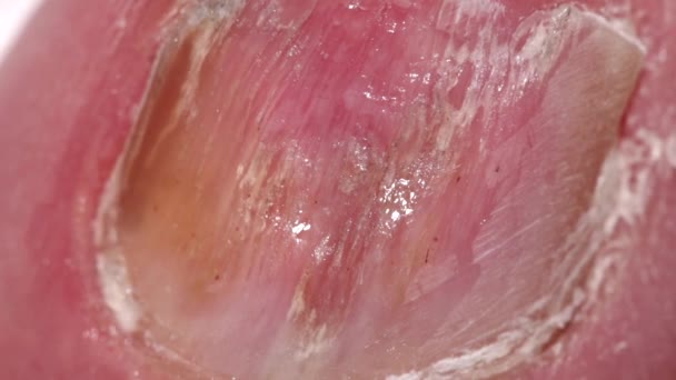 Macro fotografía de una uña de dedo gordo con onicomicosis — Vídeo de stock