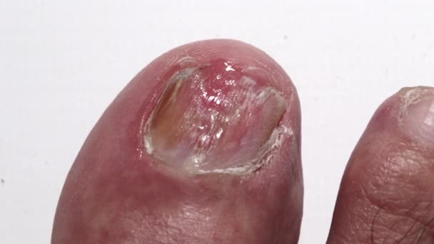 Вид большого ногтя на ноге, пораженного ногтями на ноге после лака - нанесение лака — стоковое видео