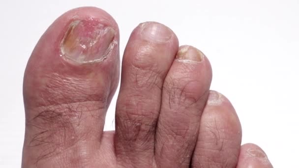 Uña del dedo gordo del pie con onicomicosis — Vídeo de stock