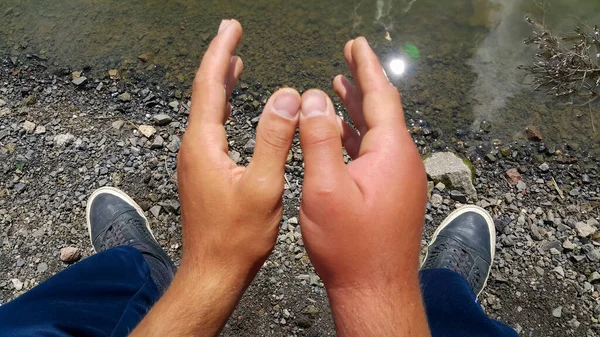 Gezwollen Hand Allergie Voor Bijensteken Twee Handen Van Een Persoon — Stockfoto