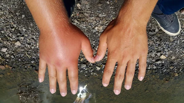 Πρησμένο Χέρι Αλλεργία Τσιμπήματα Μέλισσας Δύο Χέρια Ενός Ανθρώπου — Φωτογραφία Αρχείου