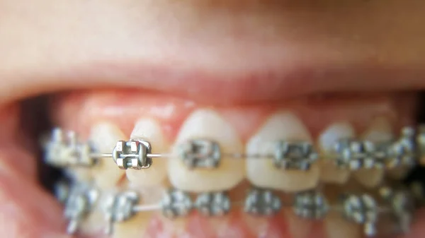Teeth with braces or braces in an open human mouth. Selective focus on one bracket. Dental care. Straightened teeth.