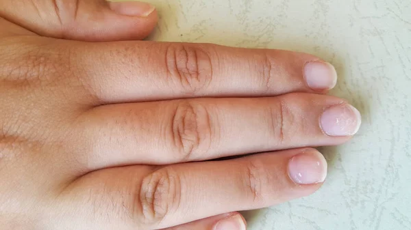 Uma Protuberância Apareceu Ponta Dedo Médio Aluno Devido Fato Que — Fotografia de Stock