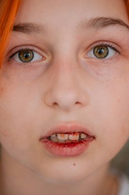 Dudağı patlamış küçük bir kız. Dudağı patlamış bir kız. Gençlik dudağını incitti.