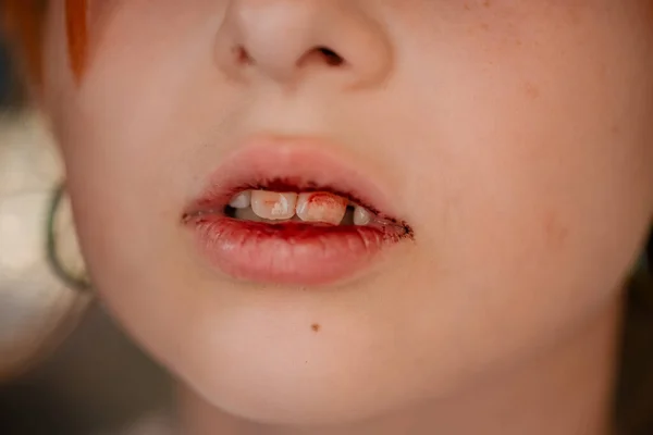 little girl with a broken lip. Girl with a broken lip. Teen hurt her lip