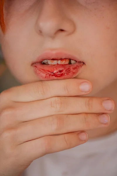 little girl with a broken lip. Girl with a broken lip. Teen hurt her lip