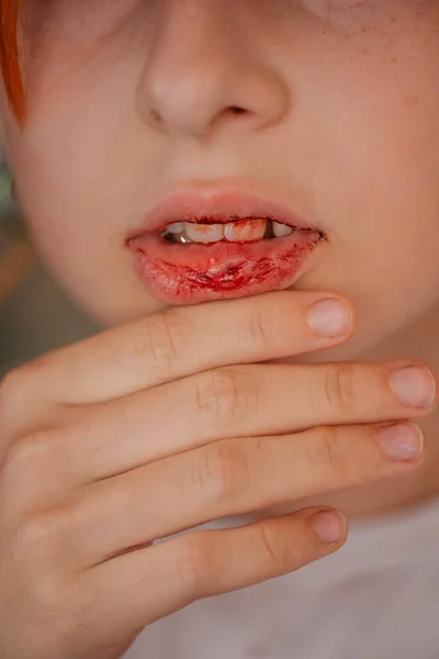 입술부러진 입술이 부러진 소녀가 입술을 다쳤다 — 스톡 사진