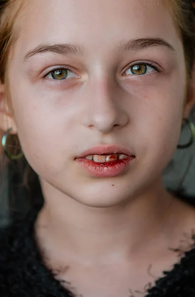 Kleines Mädchen Mit Gebrochener Lippe Mädchen Mit Gebrochener Lippe Teenager — Stockfoto