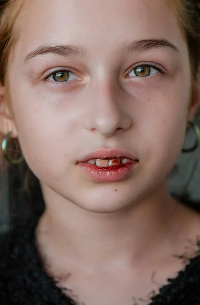 Menina Com Lábio Quebrado Uma Rapariga Com Lábio Partido Adolescente — Fotografia de Stock