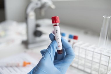 Elinde tutan olumlu bir HIV testi teşhis.