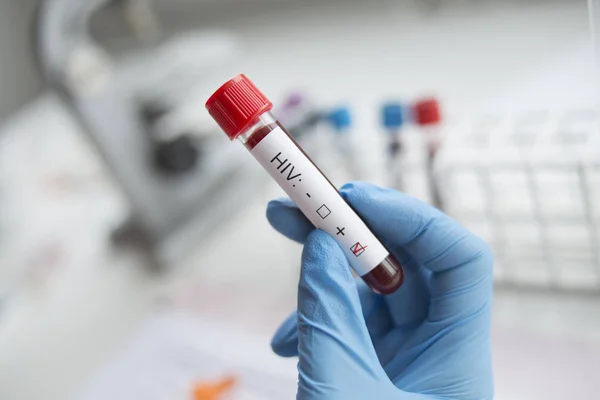 Teknikerns Håller Handen Ett Positivt Hivtest — Stockfoto