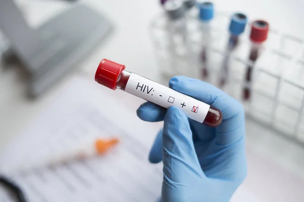 Diagnóstico Segurando Mão Teste Hiv Positivo — Fotografia de Stock