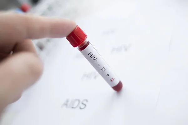 Diagnosta Trzymając Ręku Pozytywny Test Hiv — Zdjęcie stockowe