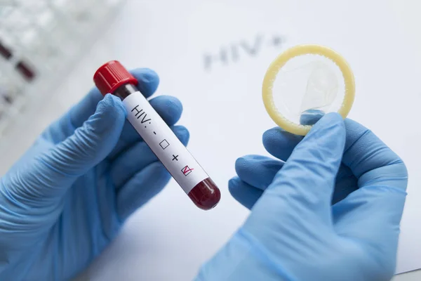 Diagnostician holding in hand a positive HIV test.