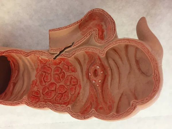 Starý Anatomický Model Tlustého Střeva Příklady Různých Onemocnění — Stock fotografie