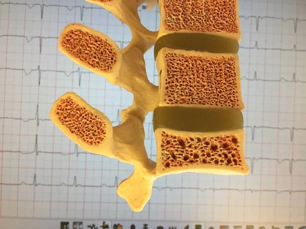 Old anatomical model of human spine showing vertebral disks, spinal canal and different levels of osteoporosis