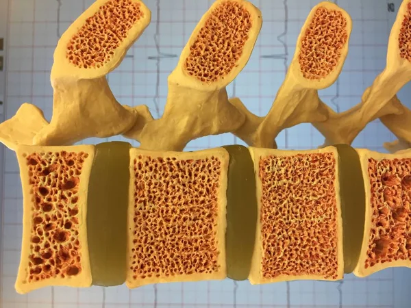 Old anatomical model of human spine showing vertebral disks, spinal canal and different levels of osteoporosis