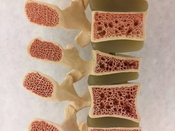 Old anatomical model of human spine showing vertebral disks, spinal canal and different levels of osteoporosis