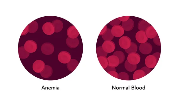 Ilustración de células sanguíneas planas vectoriales. Eritrocitos de gradiente rojo en un conjunto de marcos de círculo aislados sobre fondo blanco. Concepto de anemia. Elemento de diseño para póster, volante, tarjeta, banner, ui, presentación — Vector de stock