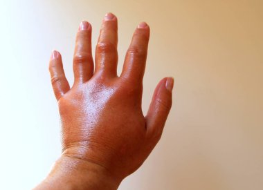 Sol kolu arı sokmasından sonra ciddi şekilde şişmiş, bu da iğnesinin derisini zehirlemiş..