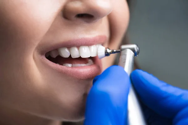 Processus d'utilisation de la brosse stomatologique comme étape de la procédure de nettoyage dentaire professionnelle en clinique close up — Photo