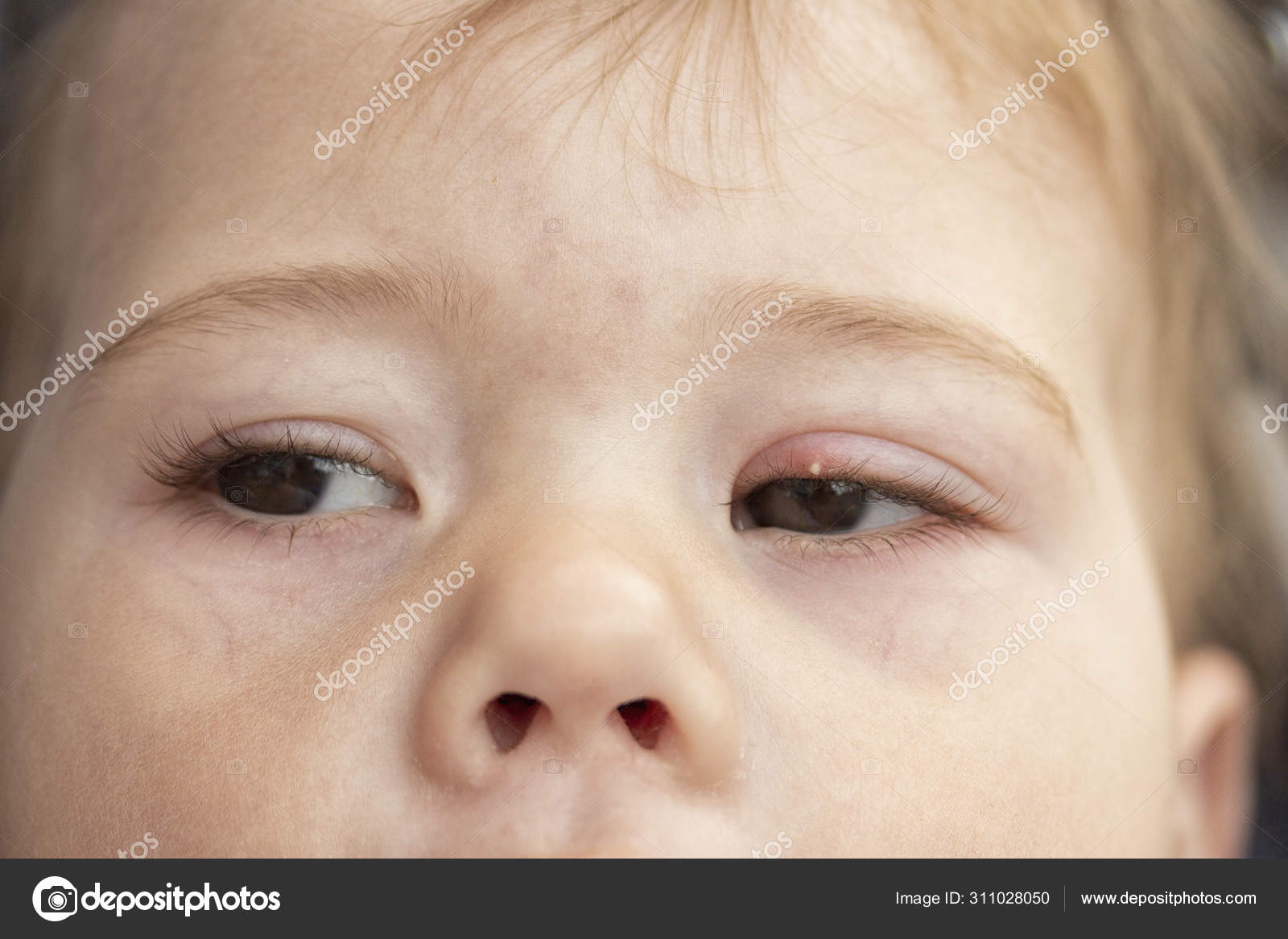 White Pimple On The Upper Eyelid Of The Eye Milium Inflammation Of The Eye Of A Small Baby Child Conjunctivitis Milium Is A Small Hard Pale Keratinous Nodule Formed On The Skin White Pimple On The Upper Eyelid Of The Eye Milium Inflammation Of The Eye Of A Small Baby Child Conjunctivitis Milium Is A Small Hard Pale Keratinous Nodule Formed On The Skin