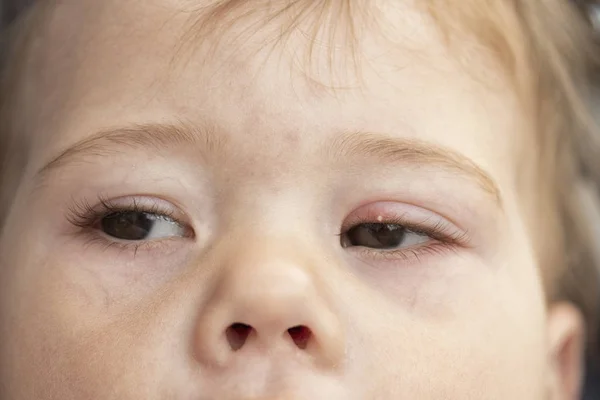 Witte puistje op het bovenste ooglid van het oog, Milium. Ontsteking van het oog van een klein baby kind, conjunctivitis. Milium is een kleine, harde, bleke keratineuze knobbel gevormd op de huid zachte focus — Stockfoto