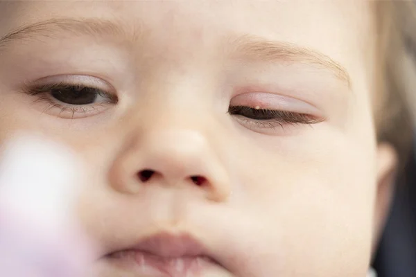 Witte puist op het ooglid van een klein kind van dichtbij. Ontsteking van de oogmilium conjunctivitis — Stockfoto