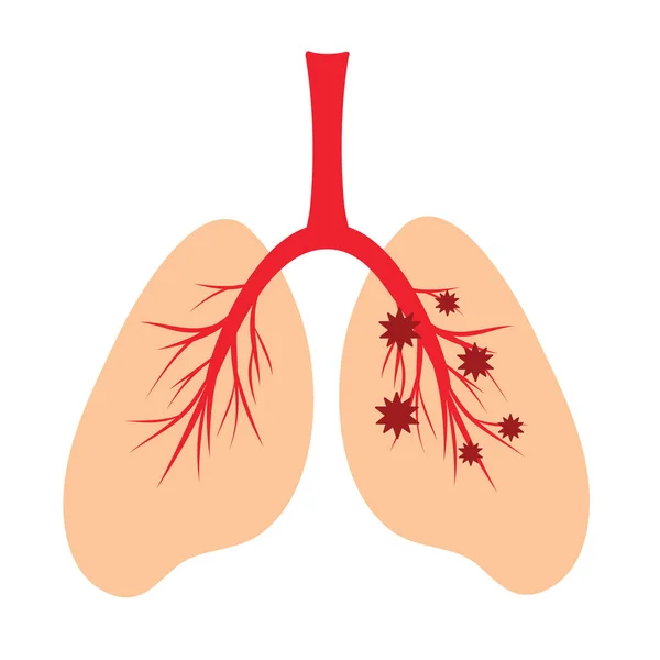 Lidské Plíce Schematická Barevná Ilustrace Infekce Lidských Plic Virem Anatomická — Stockový vektor