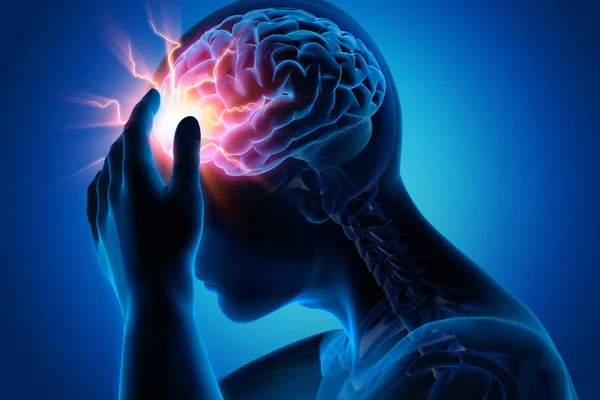 Mann mit Kopfschmerzen - Migraene - 3d illüstrasyon
