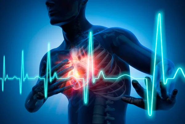 Mann mit Herzinfarkt - 3d İllüstrasyon