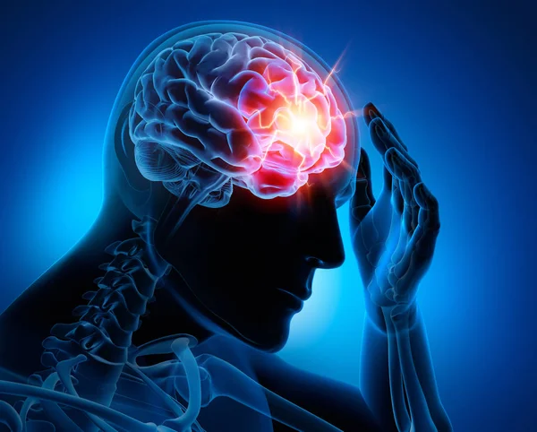 Mann mit Kopfschmerzen - Migraene - 3d illüstrasyon