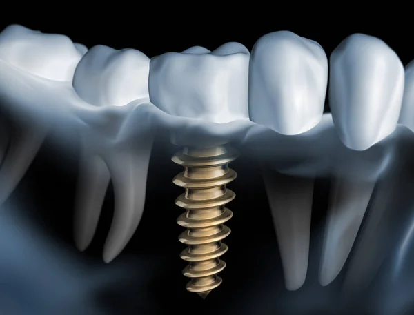 Zahnimplantat Kieferimplantat Implantat 3d Illustration