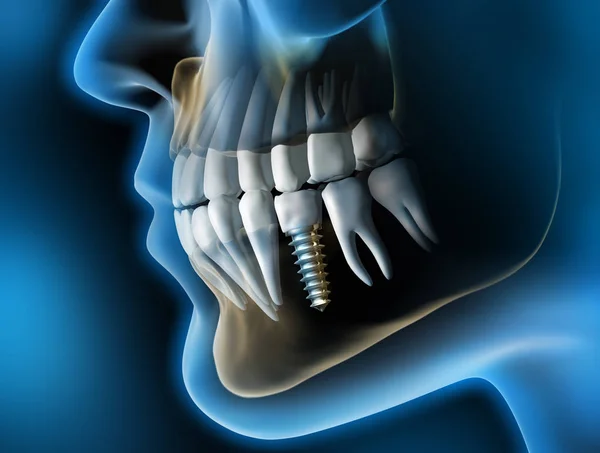 Zahnimplantat Kieferimplantat Implantat 3d Illustration