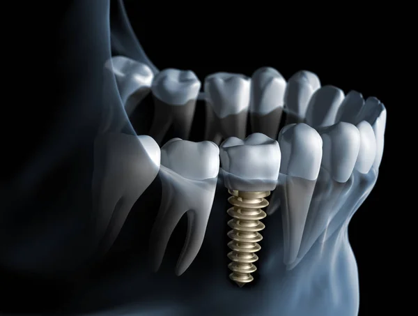 Zahnimplantat Kieferimplantat Implantat 3d Illustration